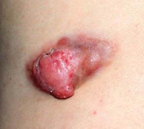 фібросаркома