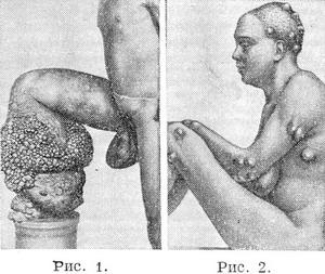 вухерериоз і онхоцеркоз