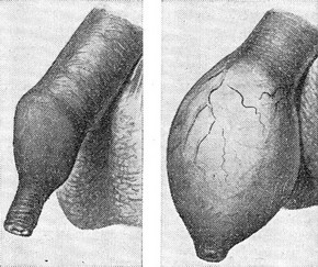 гіпертрофічний фімоз фото