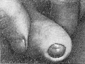 атрофічний фімоз