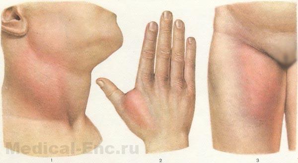 флегмона шиї кисті стегна