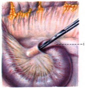 кишені очеревини