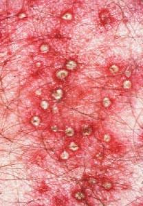 поверхневий фолікуліт фото