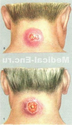 фурункул фото