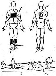 загальна гальванізація (по Вермелю)