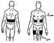 гальванічний пояс (локалізація електродів).