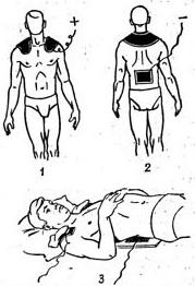 Гальванічний комір по Щербаку