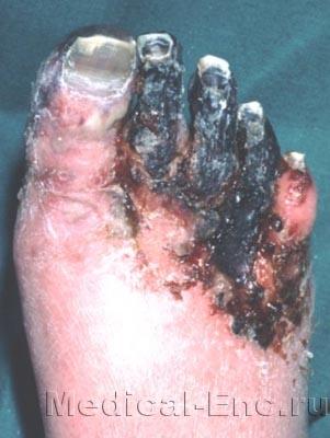 гангрена ноги фото