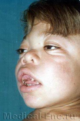 гаргоилизм