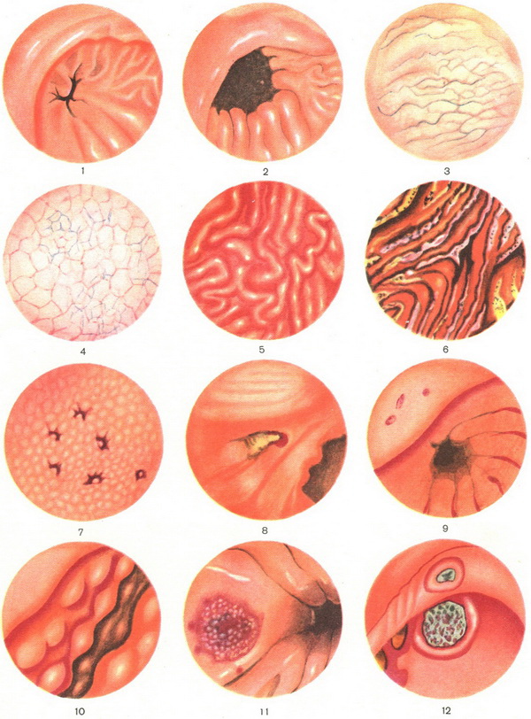 гастроскопія