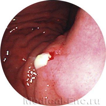 виразка шлунка фото