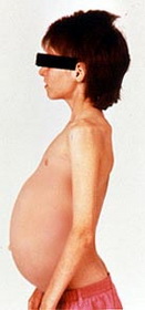 Хвороба Гоше