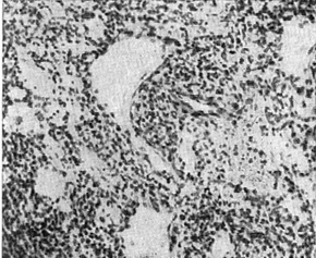 злоякісна гемангиоэндотелиома