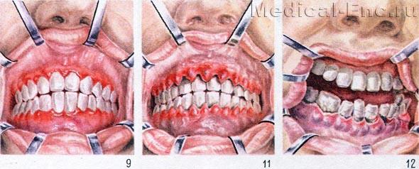катальный, гіпертрофічний і цинготним гінгівіт