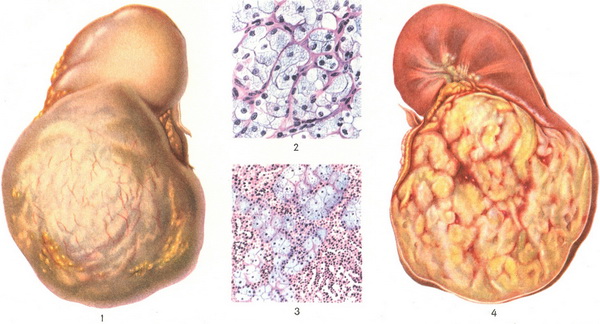 гіпернефрома нирки