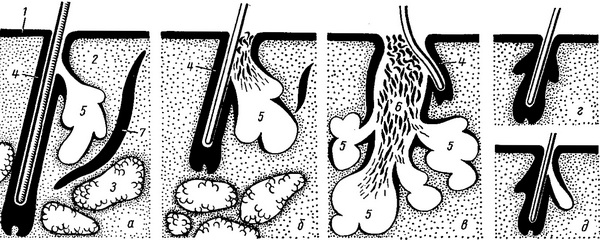 великі і малі сальні залози схема