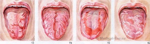 глосит запалення мови