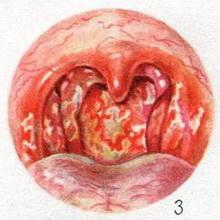 туберкульоз глотки