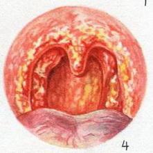 вовчак глотки