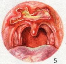 сифіліс (гума м'якого неба)
