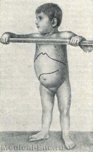 Гликогенная хвороба