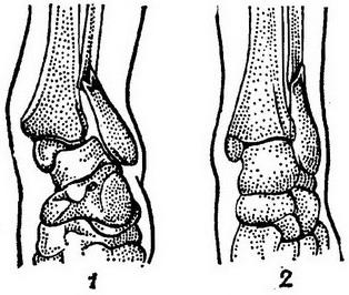 перелом Дюпюітрена