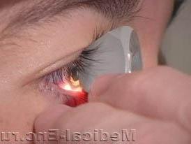 гоніоскопію