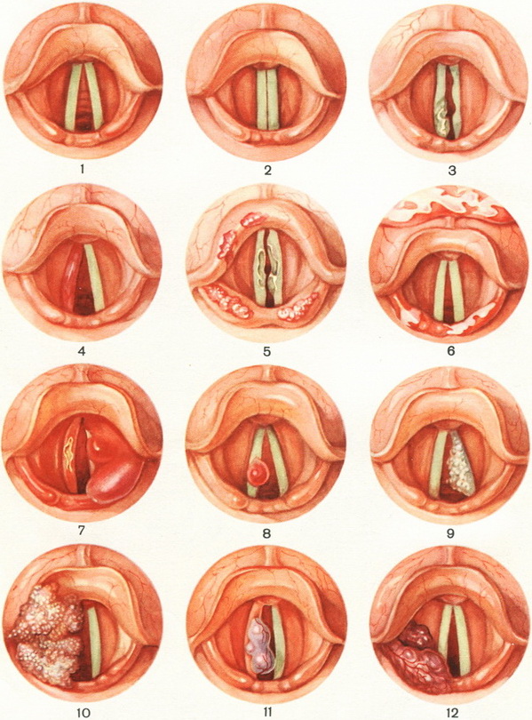 хвороби гортані