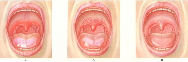 зміни слизової оболонки м'якого піднебіння при грипі