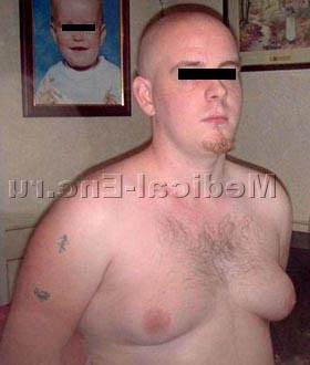 гінекомастія фото
