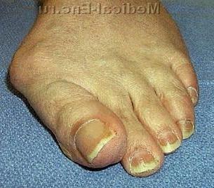 hallux valgus