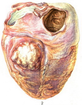 метастаз раку в серці