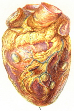 цистицеркоз серця