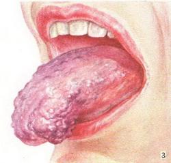 гемангіома мови