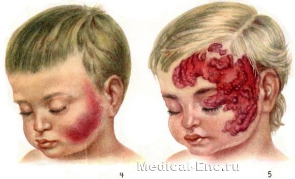 капілярна і кавернозна гемангіома фото