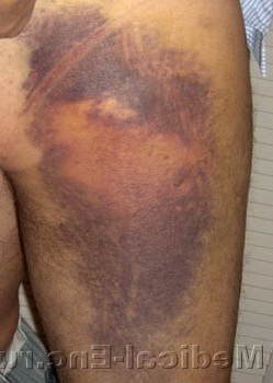 гематома на нозі