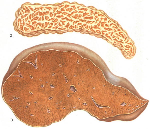 гемохроматоз
