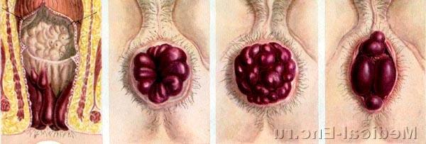 геморой фото