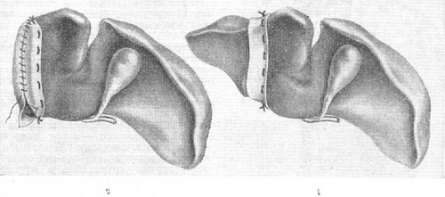 резекція печінки