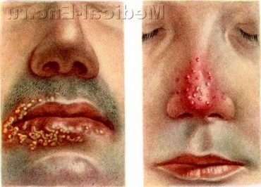 простий герпес