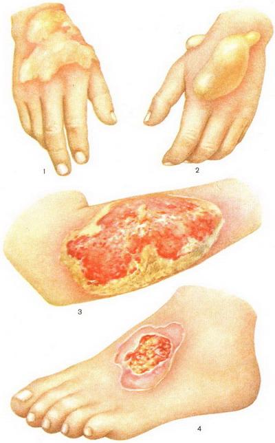 ураження іпритом