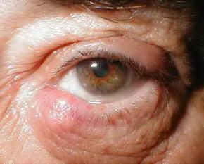 ячмінь на оці фото