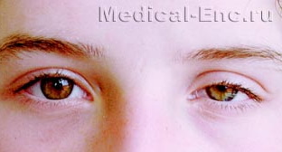 Синдром Горнера