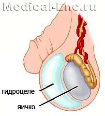 гідроцеле (водянка яєчка)