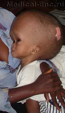 гідроцефалія водянка головного мозку