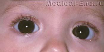 гидрофтальм водянка ока