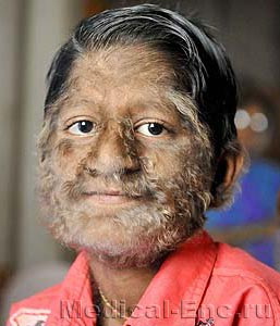 волосатість (гіпертрихоз)