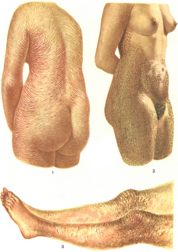 іхтіоз риб'яча луска