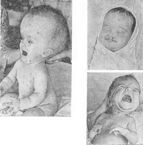 діти з алкогольним синдромом