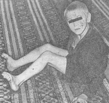 дитячий церебральний параліч